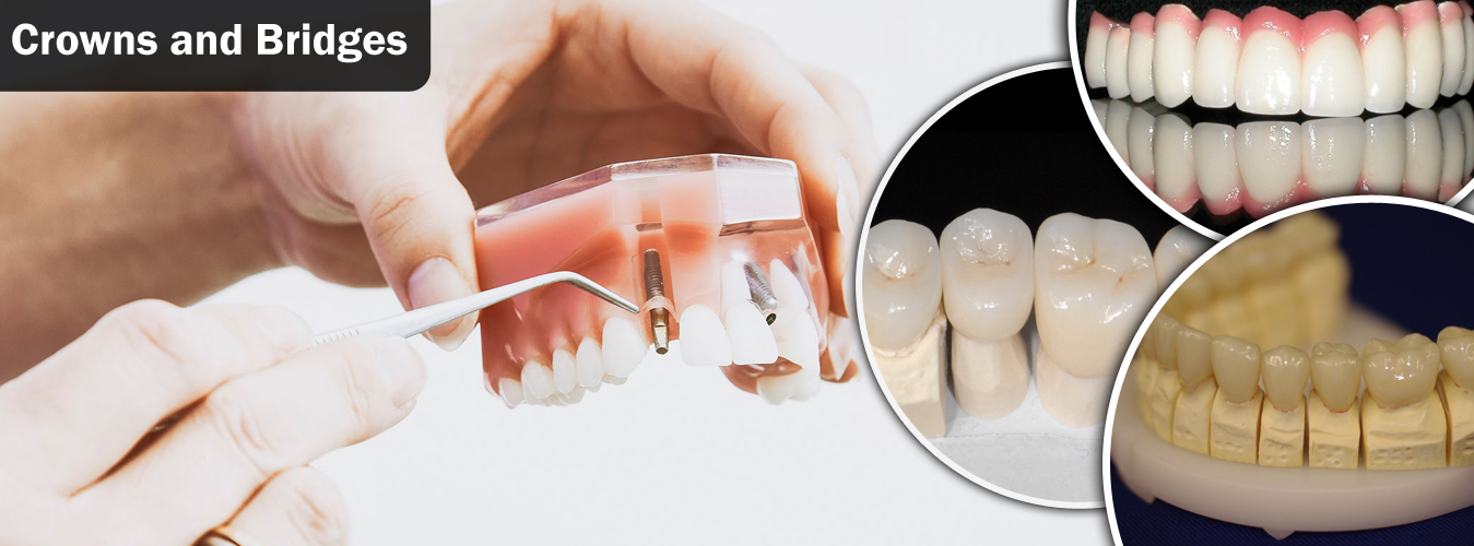 Dental Crowns and Bridges In Pimpri Chinchwad Dental Crowns and Bridges In Pimpri Chinchwad Pune