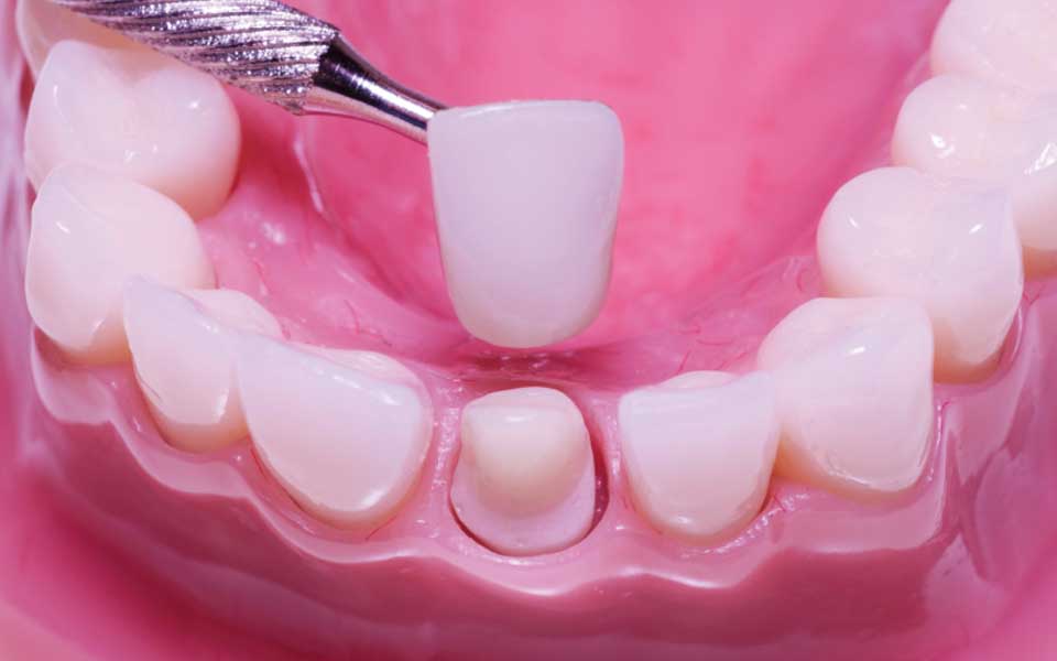 Dental Crowns and Bridges In Pimpri Chinchwad Pune