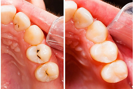 Dental Crowns and Bridges In Pimpri Chinchwad Pune