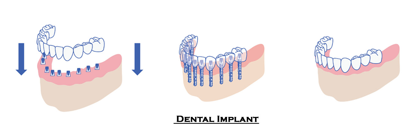 Best Dental Implant Clinic in Pimpri Chinchwad Best Dental Implant Clinic in Pimpri Chinchwad Pune