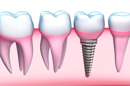 Dental Crowns and Bridges In Pimpri Chinchwad Pune