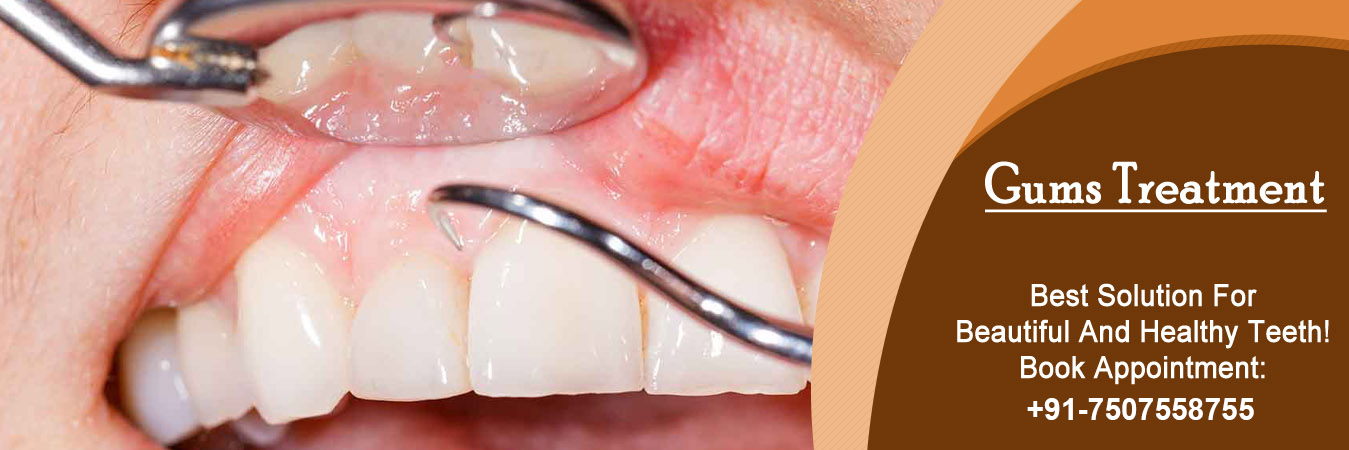 Gum Surgery Treatment in Pimpri Chinchwad Gum Surgery Treatment in Pimpri Chinchwad Pune