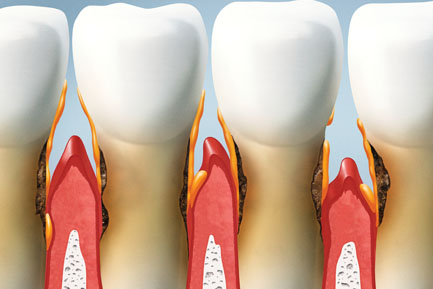 Gum Surgery Treatment in Pimpri Chinchwad Pune