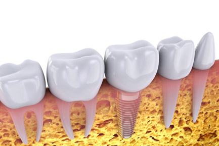 Best Dental Implant Clinic in Pimpri Chinchwad Pune