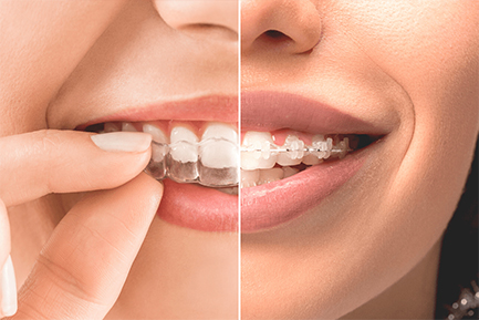 Best Orthodontist in Pimpri Chinchwad Pune