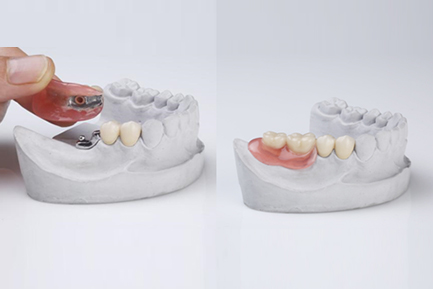 Dental Crowns and Bridges In Pimpri Chinchwad Pune
