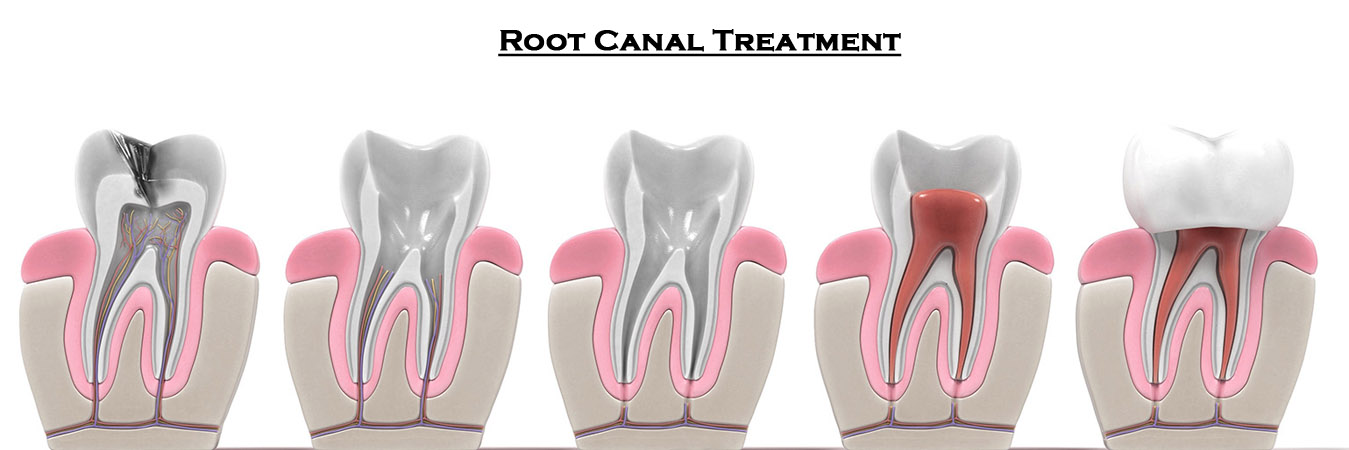 Root Canal Treatment in Pimpri Chinchwad Root Canal Treatment in Pimpri Chinchwad Pune