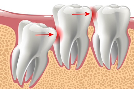 Dental Crowns and Bridges In Pimpri Chinchwad Pune